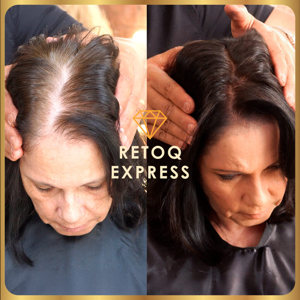 Comparação lado a lado de uma mulher mostrando cabelos ralos à esquerda e cabelos mais cheios e escuros à direita. Um par de mãos segura sua cabeça em ambas as imagens. O texto RETOQ EXPRESS está sobreposto no centro.