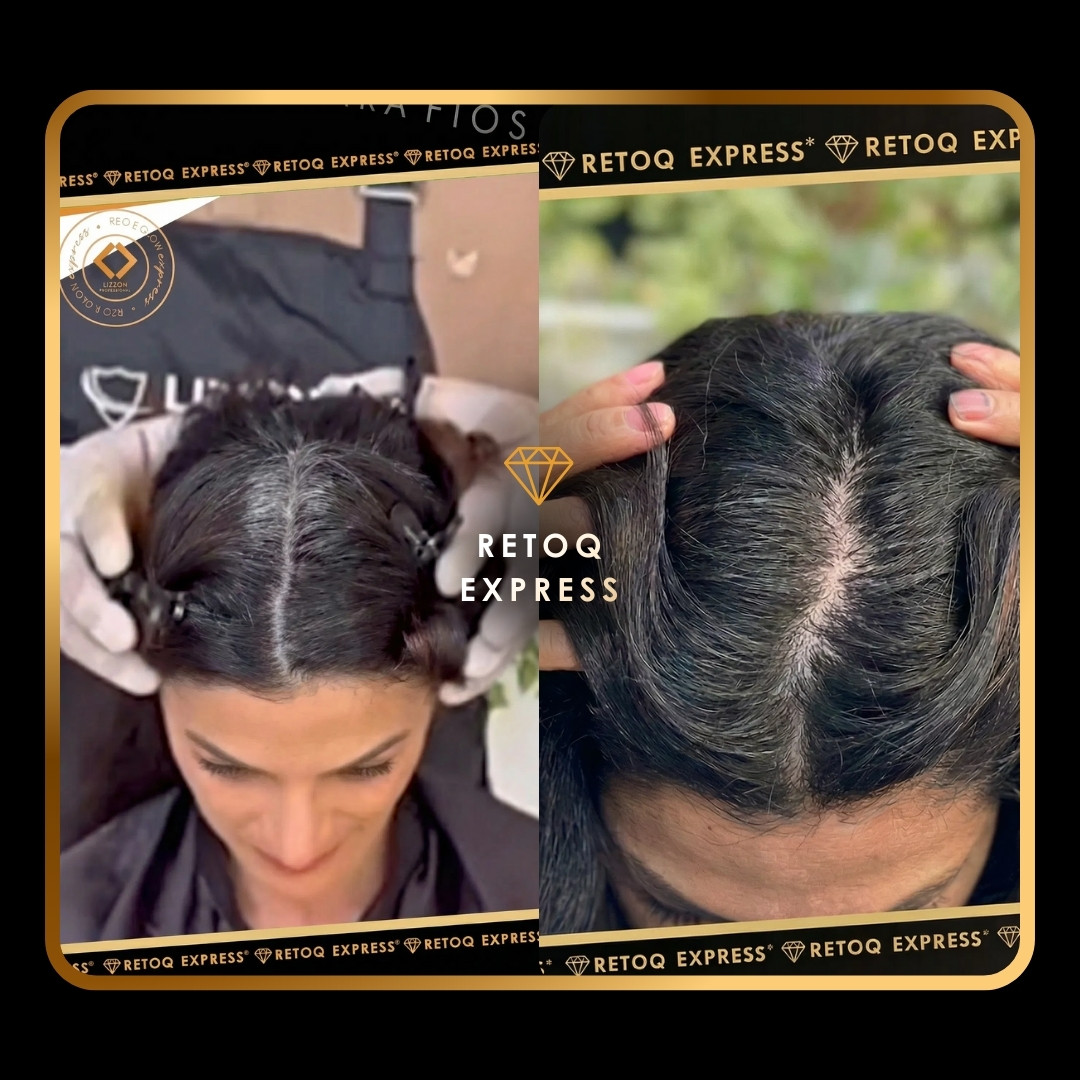 Duas imagens lado a lado mostram o topo da cabeça de uma pessoa, separando o cabelo para revelar as raízes. A imagem à esquerda mostra raízes mais escuras; a imagem à direita mostra raízes mais claras e cinzas com o couro cabeludo mais visível. Mãos com luvas seguram o cabelo.